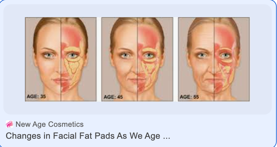 Why is it important to address fat pads in the face as we age? And how to fix this aging issue.